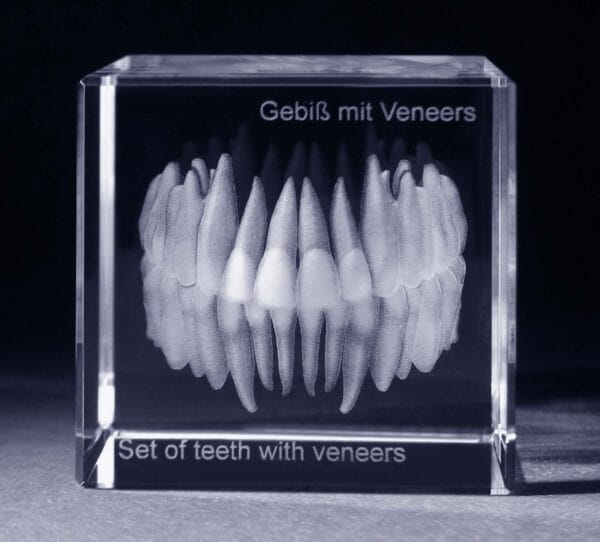Tänder med veneers - 3D Kristall skapad av Crafted In Crystal